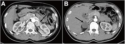 A Novel Phenotype of Germline Pathogenic Variants in MAX: Concurrence of Pheochromocytoma and Ganglioneuroma in a Chinese Family and Literature Review